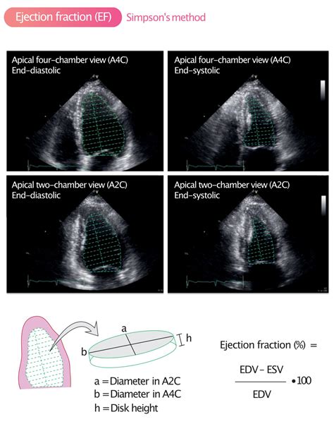 Ejection fraction (EF): Physiology, Measurement.